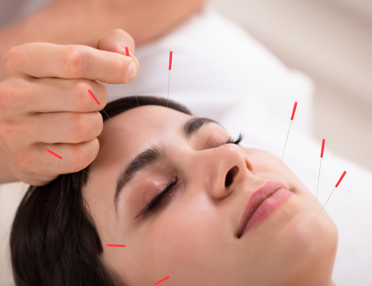 Acupuncture Treatment at Samatvam Wellness